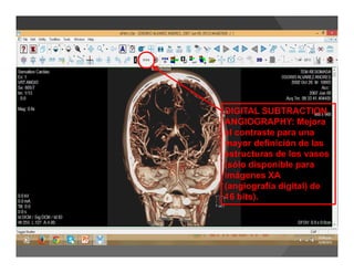 DIGITAL SUBTRACTION
ANGIOGRAPHY: Mejora
el contraste para una
mayor definición de las
estructuras de los vasos
(sólo disponible para
imágenes XA
(angiografía digital) de
16 bits).
 