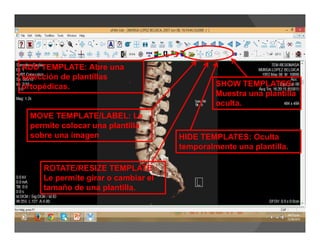 ADD TEMPLATE: Abre una
selección de plantillas
ortopédicas.
MOVE TEMPLATE/LABEL: Le
permite colocar una plantilla
sobre una imagen
ROTATE/RESIZE TEMPLATE :
Le permite girar o cambiar el
tamaño de una plantilla.
HIDE TEMPLATES: Oculta
temporalmente una plantilla.
SHOW TEMPLATES:
Muestra una plantilla
oculta.
 