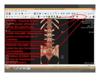 View 3D : Presenta la serie
seleccionada utilizando el
modo 3D especificado..
ROTATE VOLUME: Gira el volumen
sobre los ejes horizontal y vertical
de la pantalla.
CROP VOLUME: ARecorta las
partes no deseadas de un
volumen.
TOGGLE STEREO: Alterna el
modo de visualización
estereoscópico.
 