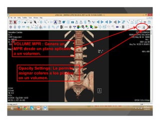 VOLUME MPR : Genera un
MPR desde un plano aplicado
a un volumen.
Opacity Settings: Le permite
asignar colores a los píxeles
en un volumen.
 
