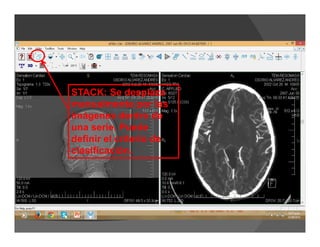 STACK: Se desplaza
manualmente por las
imágenes dentro de
una serie. Puede
definir el criterio de
clasificación.
 