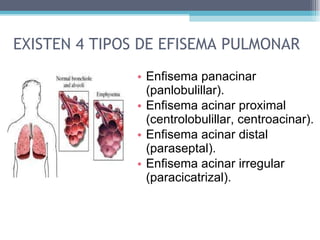 EXISTEN 4 TIPOS DE EFISEMA PULMONAR Enfisema panacinar (panlobulillar).  Enfisema acinar proximal (centrolobulillar, centroacinar).  Enfisema acinar distal (paraseptal).  Enfisema acinar irregular (paracicatrizal).  