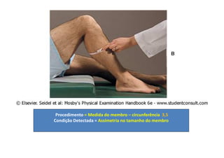 Procedimento = Medida do membro – circunferência 3,5
Condição Detectada = Assimetria no tamanho do membro
 