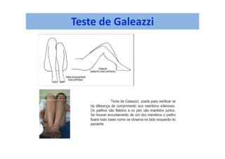 Teste de Galeazzi
 