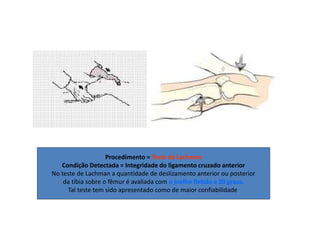 Procedimento = Teste de Lachman
Condição Detectada = Integridade do ligamento cruzado anterior
No teste de Lachman a quantidade de deslizamento anterior ou posterior
da tíbia sobre o fêmur é avaliada com o joelho fletido a 20 graus.
Tal teste tem sido apresentado como de maior confiabilidade
 