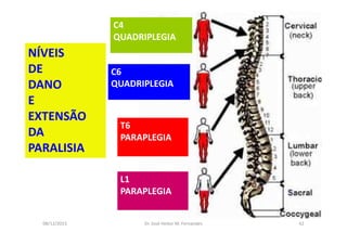 08/12/2015 Dr. José Heitor M. Fernandes 42
C4
QUADRIPLEGIA
C6
QUADRIPLEGIA
T6
PARAPLEGIA
L1
PARAPLEGIA
NÍVEIS
DE
DANO
E
EXTENSÃO
DA
PARALISIA
 