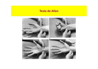 Teste de Allen
 