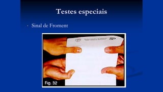 Testes especiais
 Sinal de Froment
 