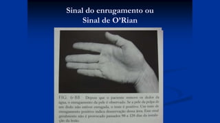 Sinal do enrugamento ou
Sinal de O’Rian
 