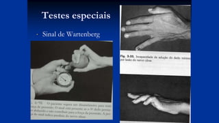 Testes especiais
 Sinal de Wartenberg
 