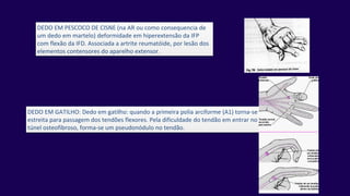 DEDO EM PESCOCO DE CISNE (na AR ou como consequencia de
um dedo em martelo) deformidade em hiperextensão da IFP
com flexão da IFD. Associada a artrite reumatóide, por lesão dos
elementos contensores do aparelho extensor.
DEDO EM GATILHO: Dedo em gatilho: quando a primeira polia arciforme (A1) torna-se
estreita para passagem dos tendões flexores. Pela dificuldade do tendão em entrar no
túnel osteofibroso, forma-se um pseudonódulo no tendão.
 