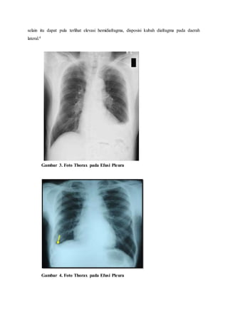 selain itu dapat pula terlihat elevasi hemidiafragma, disposisi kubah diafragma pada daerah
lateral.4
Gambar 3. Foto Thorax pada Efusi Pleura
Gambar 4. Foto Thorax pada Efusi Pleura
 
