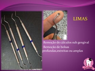 •Remoção de cálculos sub gengival
•Remoção de bolsas
profundas,estreitas ou amplas
LIMAS
 