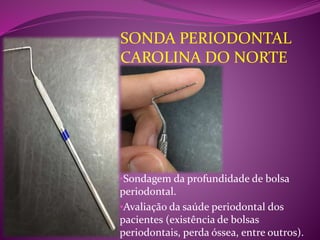 •Sondagem da profundidade de bolsa
periodontal.
•Avaliação da saúde periodontal dos
pacientes (existência de bolsas
periodontais, perda óssea, entre outros).
SONDA PERIODONTAL
CAROLINA DO NORTE
 