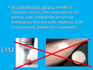 • Δεν τοποθετούμε κρέμες, αλοιφές ή
ελαιούχες ουσίες στην εγκαυματική επι-
φάνεια, γιατί η αφαίρεση αυτών των
επαλείψεων θα είναι πολύ επώδυνη, όταν
ο εγκαυματίας φτάσει στο νοσοκομείο.
 