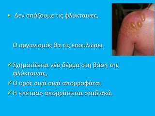 • Δεν σπάζουμε τις φλύκταινες.
Ο οργανισμός θα τις επουλώσει
Σχηματίζεται νέο δέρμα στη βάση της
φλύκταινας,
Ο ορός σιγά σιγά απορροφάται
Η «πέτσα» απορρίπτεται σταδιακά.
 