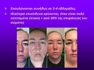  Επουλώνονται συνήθως σε 3-4 εβδομάδες.
 Ιδιαίτερα επικίνδυνα κρίνονται, όταν είναι πολύ
εκτεταμένα έκταση > από 30% της επιφάνειας του
σώματος
 