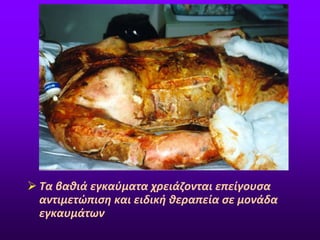  Τα βαθιά εγκαύματα χρειάζονται επείγουσα
αντιμετώπιση και ειδική θεραπεία σε μονάδα
εγκαυμάτων
 