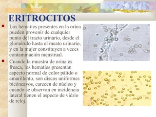 ERITROCITOS
   Los hematíes presentes en la orina
    pueden provenir de cualquier
    punto del tracto urinario, desde el
    glomérulo hasta el meato urinario,
    y en la mujer constituyen a veces
    contaminación menstrual.
   Cuando la muestra de orina es
    fresca, los hematíes presentan
    aspecto normal de color pálido o
    amarillento, son discos uniformes
    bicóncavos, carecen de núcleo y
    cuando se observan en incidencia
    lateral tienen el aspecto de vidrio
    de reloj.
 