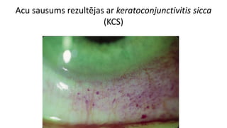 Acu sausums rezultējas ar keratoconjunctivitis sicca
(KCS)
 