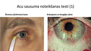Acu sausuma noteikšanas testi (1)
Širmera (Schirmer) tests Krāsojums ar bengāļu sārto
 
