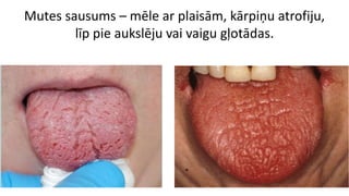 Mutes sausums – mēle ar plaisām, kārpiņu atrofiju,
līp pie aukslēju vai vaigu gļotādas.
 