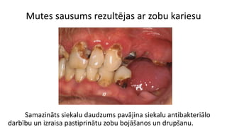 Mutes sausums rezultējas ar zobu kariesu
Samazināts siekalu daudzums pavājina siekalu antibakteriālo
darbību un izraisa pastiprinātu zobu bojāšanos un drupšanu.
 
