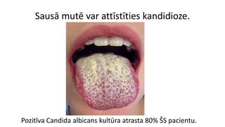 Sausā mutē var attīstīties kandidioze.
Pozitīva Candida albicans kultūra atrasta 80% ŠS pacientu.
 
