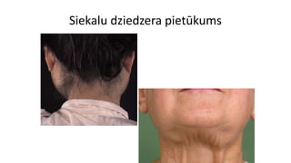 Siekalu dziedzera pietūkums
 
