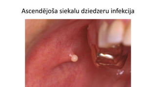 Ascendējoša siekalu dziedzeru infekcija
 