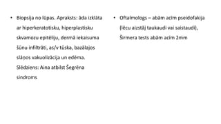 • Biopsija no lūpas. Apraksts: āda izklāta
ar hiperkeratotisku, hiperplastisku
skvamozu epitēliju, dermā iekaisuma
šūnu infiltrāti, as/v tūska, bazālajos
slāņos vakuolizācija un edēma.
Slēdziens: Aina atbilst Šegrēna
sindroms
• Oftalmologs – abām acīm pseidofakija
(lēcu aizstāj taukaudi vai saistaudi),
Širmera tests abām acīm 2mm
 