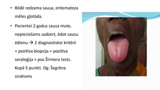 • Bildē redzama sausa, eritematoza
mēles gļotāda.
• Pacientei 2 gadus sausa mute,
nepieciešams uzdzert, ēdot sausu
ēdienu  2 diagnostiskie kritērii
+ pozitīva biopsija + pozitīva
seroloģija + poz.Širmera tests.
Kopā 5 punkti. Dg: Šegrēna
sindroms
 