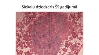 Siekalu dziedzeris ŠS gadījumā
 