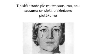 Tipiskā atrade pie mutes sausuma, acu
sausuma un siekalu dziedzeru
pietūkumu
 
