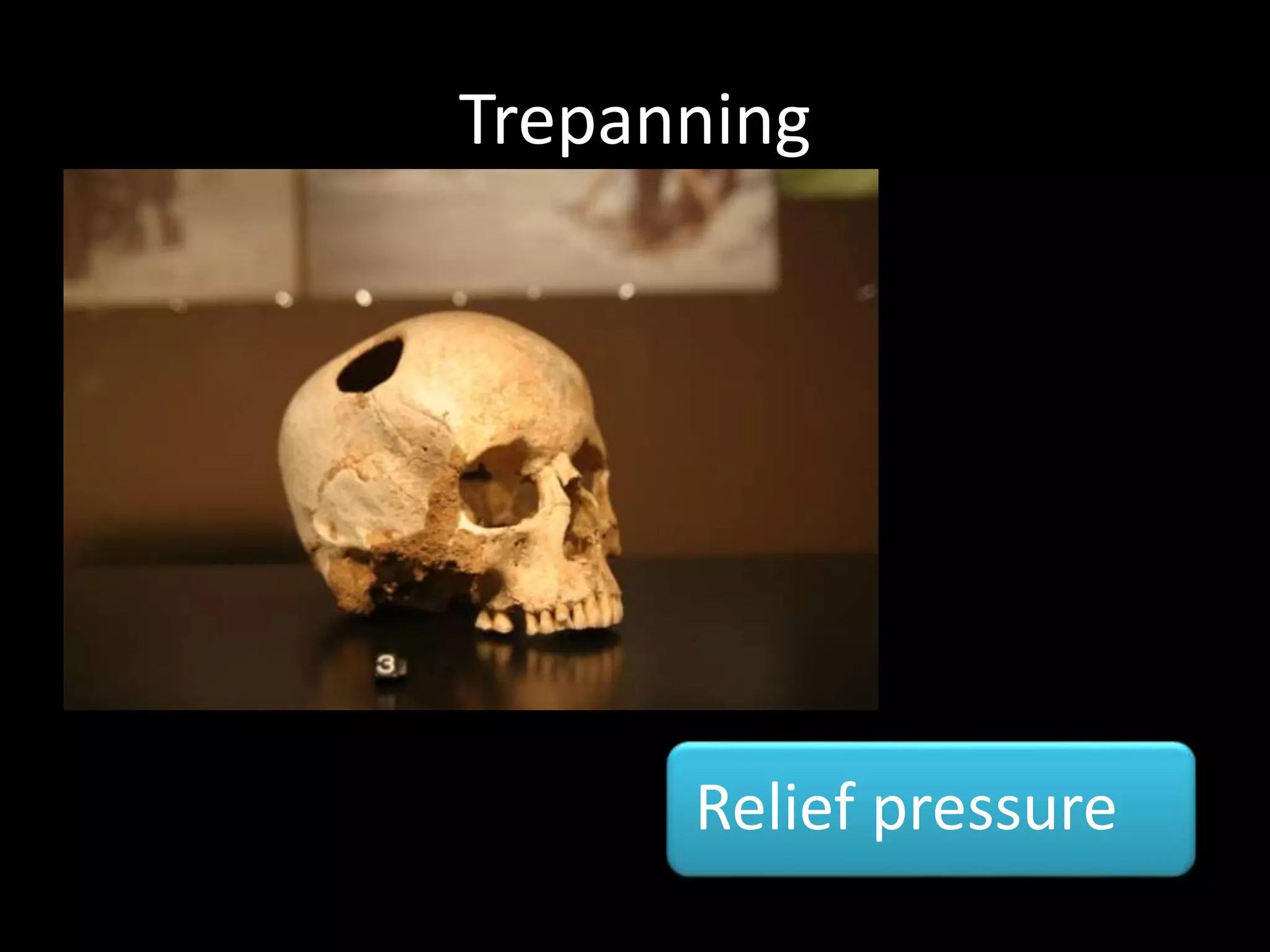 Trepanning
Relief pressure