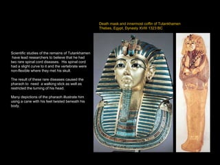 Scientific studies of the remains of Tutankhamen  have lead researchers to believe that he had two rare spinal cord diseases.  His spinal cord had a slight curve to it and the vertebrate were non-flexible where they met his skull.  The result of these rare diseases caused the pharaoh to  need  a walking stick as well as restricted the turning of his head. Many depictions of the pharaoh illustrate him using a cane with his feet twisted beneath his body. Death mask and innermost coffin of Tutankhamen Thebes, Egypt, Dynasty XVIII 1323 BC 