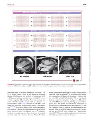 guidelines management ventricular tachycardia.pdf