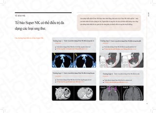 Liệu pháp miễn dịch tế bào NK được thực hiện bằng cách nuôi cấy tế bào NK chiết xuất từ máu
của bệnh nhân rồi tiêm chúng trở lại. Ngoài điều trị ung thư, nó còn cải thiện chất lượng cuộc sống
của những bệnh nhân bị suy giảm do tác dụng phụ của thuốc điều trị ung thư truyền thống.
TẾ BÀO NK
TếbàoSuper NKcóthể điều trị đa
dạngcác loạiungthư.
Các trường hợp điều trị tế bào Super NK
EHL
BIO
12
Trường hợp 1: Trước và sau khi sử dụng tế bào NK điều trị ung thư vú
Trường hợp 3: Trước và sau khi sử dụng tế bào NK điều trị ung thư gan
■ Trước khi sử dụng tế bào NK để xử lý tế bào ung thư vú(ảnh trái)
■ Tế bào ung thư vú đã giảm sau 5 tháng điều trị(ảnh phải)
Trường hợp 2: Trước và sau khi sử dụng tế bào NK điều trị ung thư phổi
Trường hợp 4: Trước và sau khi sử dụng tế bào NK điều trị u não
■ Trước khi sử dụng tế bào NK để điều trị ung thư phổi(ảnh trái)
■ Tế bào ung thư phổi đã giảm sau 3 tháng điều trị( ảnh phải)
■ Trước khi sử dụng tế bào NK để xử lý tế bào ung thư gan (ảnh trái)
■ Tế bào ung thư gan đã giảm sau điều trị(ảnh phải)
■ Trước khi sử dụng tế bào NK để xử lý u não(ảnh trái)
■ Tế bào u não đã giảm sau điều trị( ảnh phải)
 