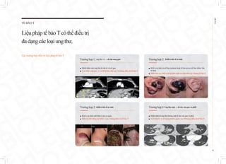 TẾ BÀO T
Liệupháptế bàoTcóthể điều trị
đadạngcác loạiungthư.
Các trường hợp điều trị liệu pháp tế bào T
EHL
BIO
16
Trường hợp 1: ung thư vú → di căn sang gan
Trường hợp 3: Khối u hắc tố ác tính
■ Bệnh nhân mắc ung thư di căn từ vú tới gan
■ Các khối u tại gan và vú đã bị tiêu diệt sau 14 tháng điều trị tế bào T
■ Khối u ác tính của tế bào melanin hoặc tế bào nevus (tế bào chấm: hắc
tố đen)
■ Phần lớn các khối u đã bị biến mất sau khi điều trị 2 tháng tế bào T
■ Khối u ác tính xuất hiện ở các cơ quan
■ Điều trị dứt điểm các khối u sau 3 tháng điều trị tế bào T
Trường hợp 2: Khối u hắc tố ác tính
Trường hợp 4 Ung thư mật → di căn vào gan và phổi
■ Bệnh nhân bị ung thư đường mật di căn vào gan và phổi
■ Kích thước và số lượng khối u giảm sau 20 tháng điều trị tế bào T
 