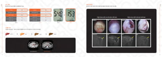 당뇨 치료
줄기세포 2회 시술 후 혈당 및 당화혈색소가 감소
Glucose 300
Hemoglobin A1c **
HbA1C-NGSP 10.8
HbA1c-IFCC 95
HbA1c-eAG 263
Glucose 120
Hemoglobin A1c **
HbA1C-NGSP 6.3
HbA1c-IFCC 45
HbA1c-eAG 134
치료 전 치료 전
치료 후 치료 후
EHL
BIO
31
간경화 치료
간경변 (59세 남성) - 치료 후 간세포가 재생되어 간의 크기가 증가하고 간 조직이 부드러워짐
치료 전(689.98ml) 치료 후(915.36ml)
출처 <Kintaro Cells Power International>
건강한 간 지방간 간 질환 간경화증
줄기세포 치료로 끊어진 회전근개를 재생·복원해 어깨 관절의 온전한 기능 회복
회전근개파열
EHL
BIO
High-dosewithanarticular-sidetear High-dosewithabursal-sidetear
32
 