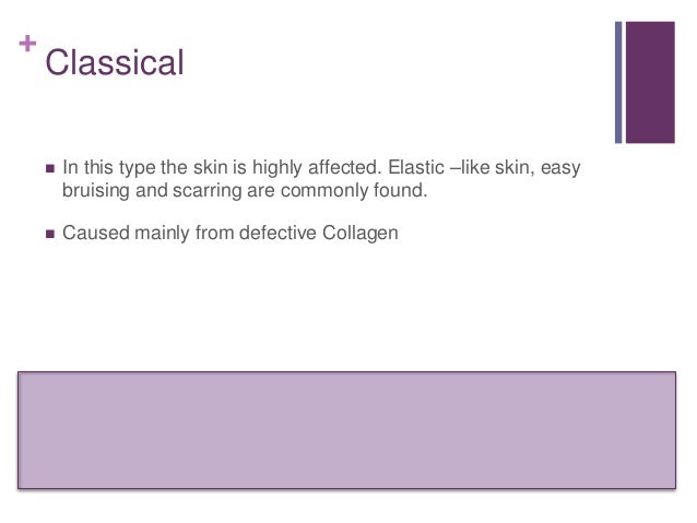 Ehlers Danlos Syndrome