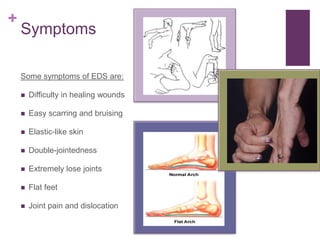 Ed's Dislocation Ehlers Danlos Syndrome | PPTX
