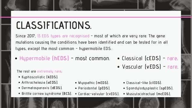 Hypermobile Ehlers Danlos Syndrome Hypermobility Spectrum Disorders