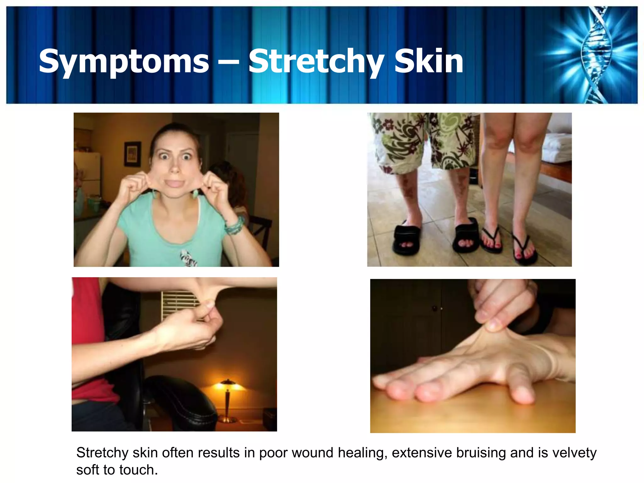 Ehlers-Danlos Syndrome & Hypermobility | PPTX