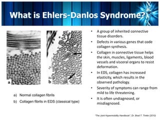 ehlers danlos syndrome type 3 photos