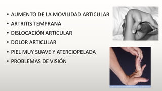 • AUMENTO DE LA MOVILIDAD ARTICULAR
• ARTRITIS TEMPRANA
• DISLOCACIÓN ARTICULAR
• DOLOR ARTICULAR
• PIEL MUY SUAVE Y ATERCIOPELADA
• PROBLEMAS DE VISIÓN
 