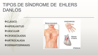 TIPOS DE SÍNDROME DE EHLERS
DANLOS
CLASICO
HIPERLAXITUD
VASCULAR
CIFOESCOLIOSIS
ARTROCALASIA
DERMATOSPARAXIS
 