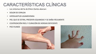 CARACTERÍSTICAS CLÍNICAS
– Los síntomas del Sx de Ehlers Danlos abarcan:
• DOLOR DE ESPALDA
• HIPERLAXITUD LIGAMENTARIA
• PIEL QUE SE ESTIRA, PRESENTA EQUIMOSIS Y SE DAÑA FÁCILMENTE
• CICATRIZACIÓN FÁCIL Y CURACIÓN DE HERIDAS DEFICIENTE
• PIES PLANOS
 