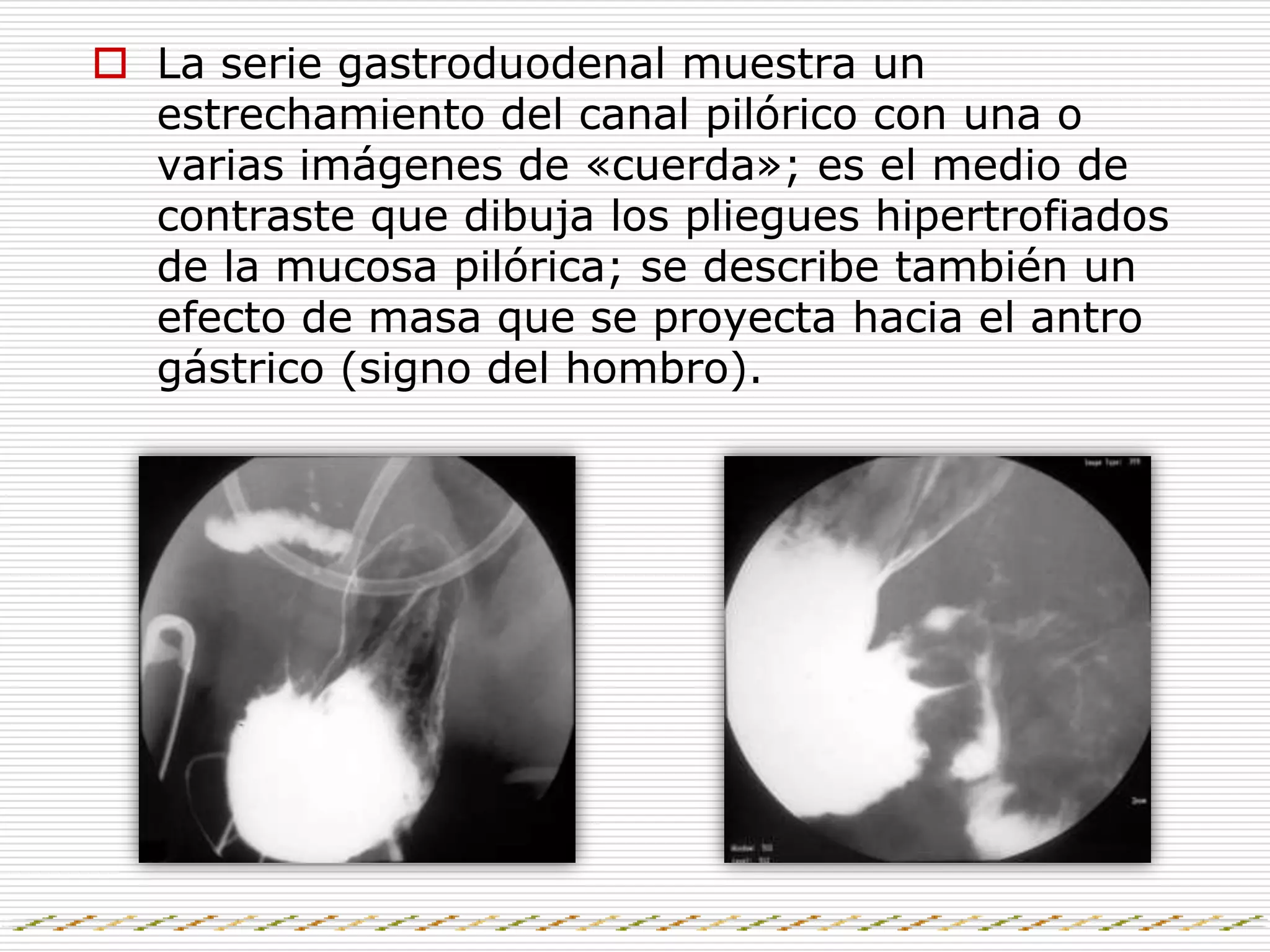 Estenosis Hipertrofica Del Piloro | PPTX