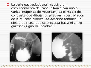 RX DE ABDOMEN    “Muestra distensión de la cámara gástrica con poco o escaso aire distal”